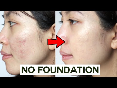 How to Cover Acne & Blemishes WITHOUT Foundation easy & non cakey